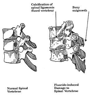 spinal damage caused by fluoride