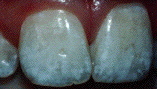 fluorosed teeth!