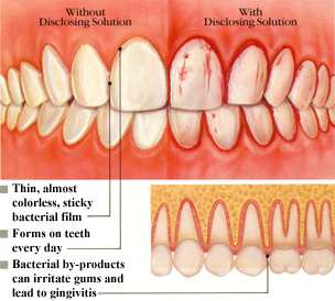 Teeth With Plaque
