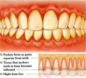 Early Periodontitis