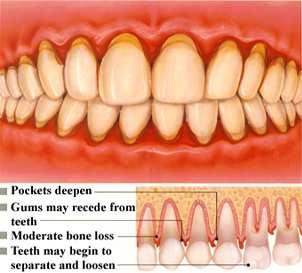 Moderate Periodontitis
